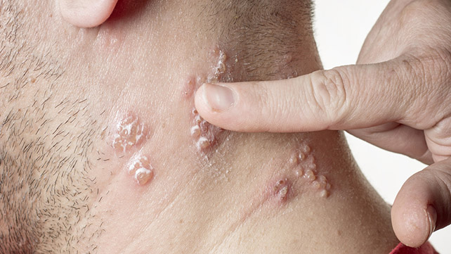 When Itching Signals Infection?