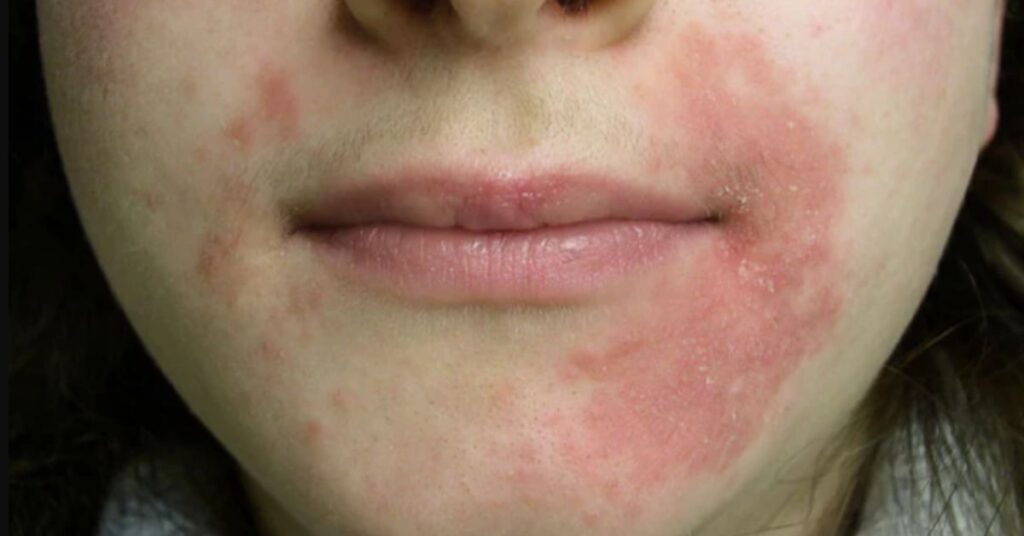 Decreased Size and Number of Papules: