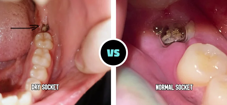 Dry Socket vs Normal Healing: