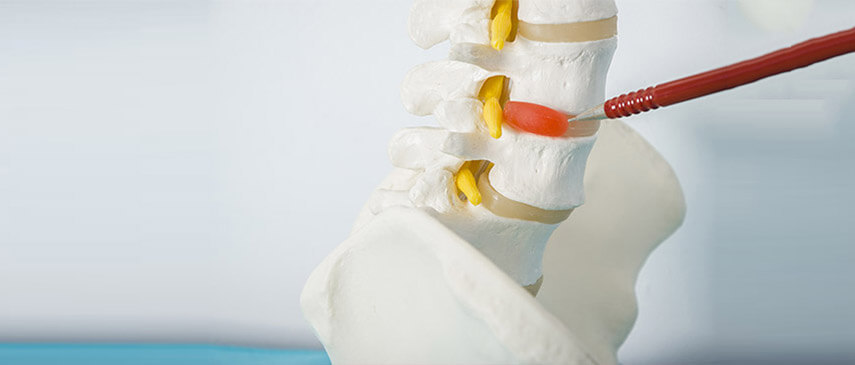 Understanding Herniated Discs: