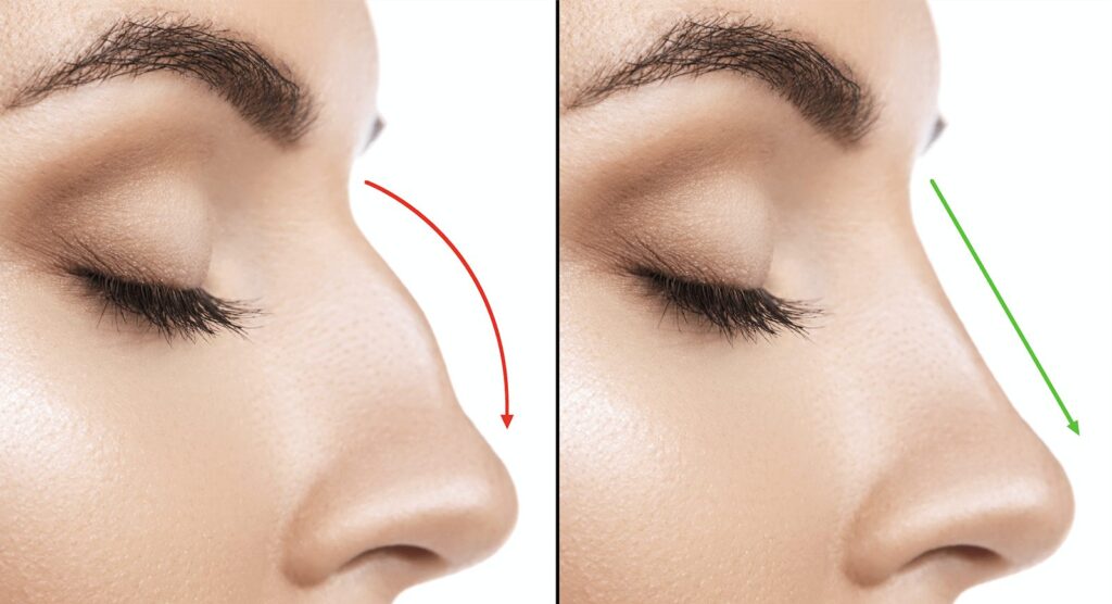 Signs Your Nose Is Healing Properly: