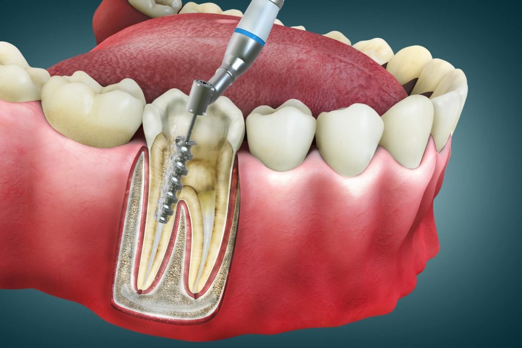 Signs Your Root Canal is Healing Properly: