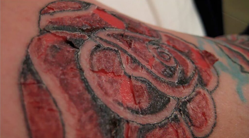 Signs of a Normal Healing Tattoo vs. Infection: