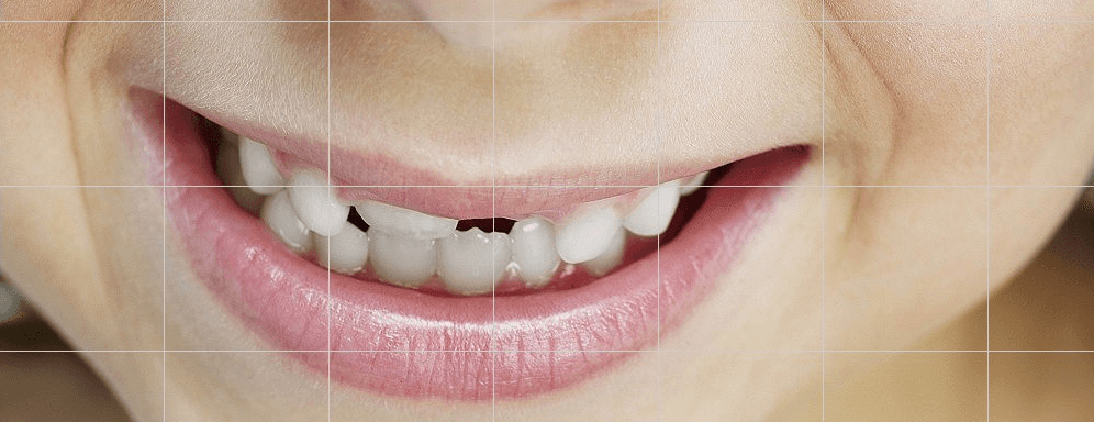 Understanding How Cavities Form and Whether Natural Healing is Possible: