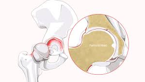 Understanding Labrum Injuries