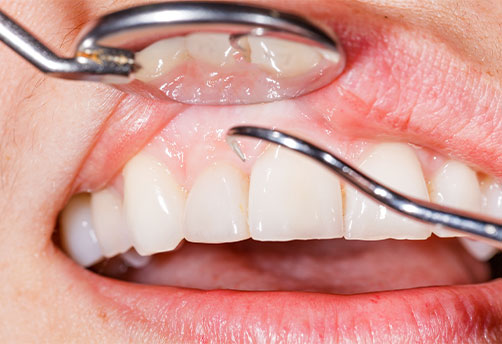 The Healing Process of Cut Gums