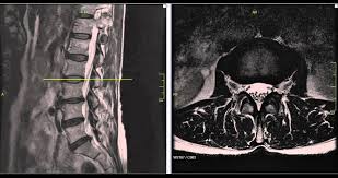 Understanding Herniated Discs: