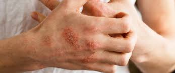 Understanding Eczema: A Struggle With Skin Health: