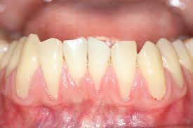 What Are Receding Gums: