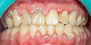 Recognizing Symptoms of Receding Gums: