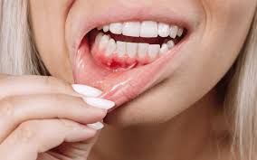 Lifestyle Changes for Healing Receding Gums: