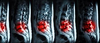 Stages of Herniated Disc Healing: