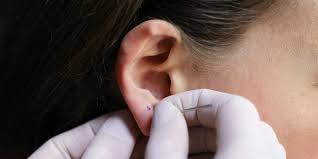 Common Issues and Solutions During Piercing Healing: