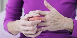 What is a Sprained Finger: