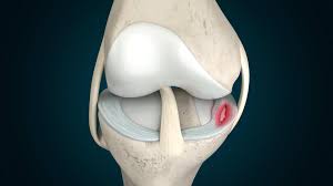 Understanding the Meniscus and How It Tears: