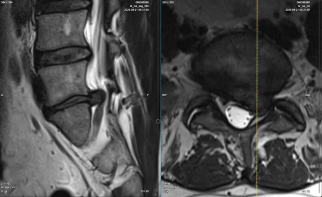 Conservative Treatments for Herniated Discs: