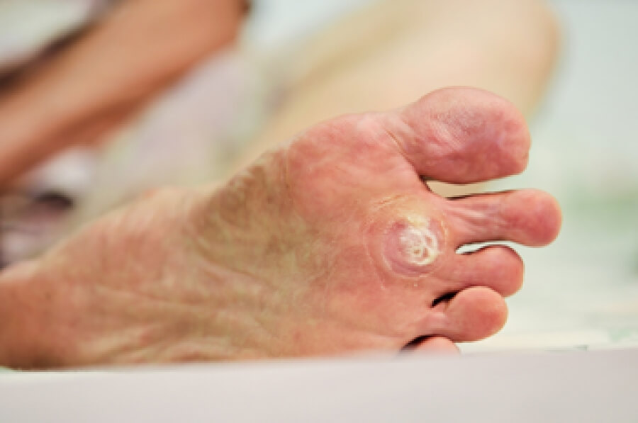 What is a Plantar Wart: