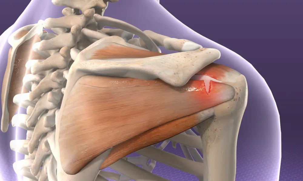 Understanding The Rotator Cuff: