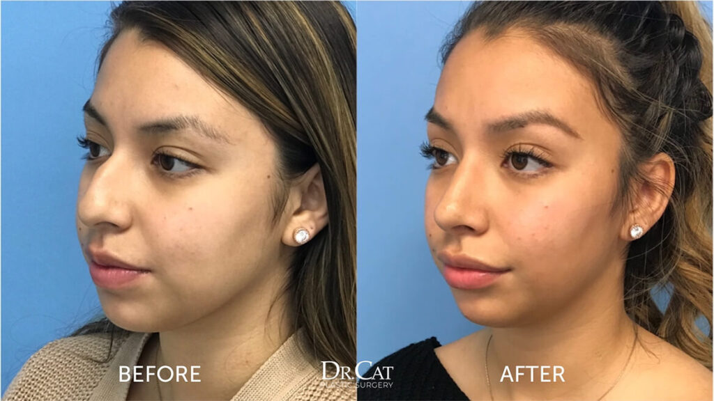 How Long Does a Nose Job Take to Heal? A Complete Timeline and Recovery Guide: