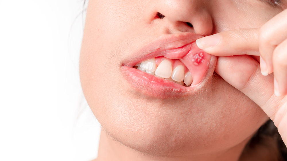 Common Causes of Mouth Cuts: