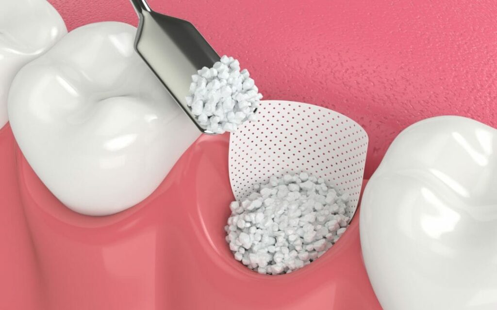 Ensure Good Oral Hygiene: (For Dental Bone Grafts):