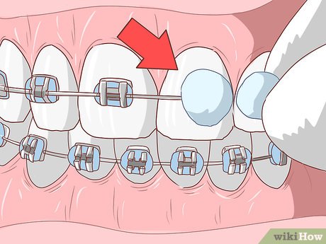 How to Heal a Cut in Your Mouth: A Comprehensive Guide: