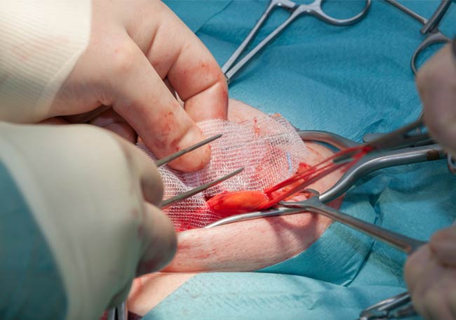 When Should Surgery Be Considered for a Hernia?