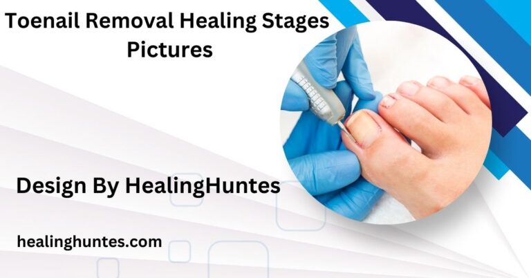 toenail removal healing stages pictures