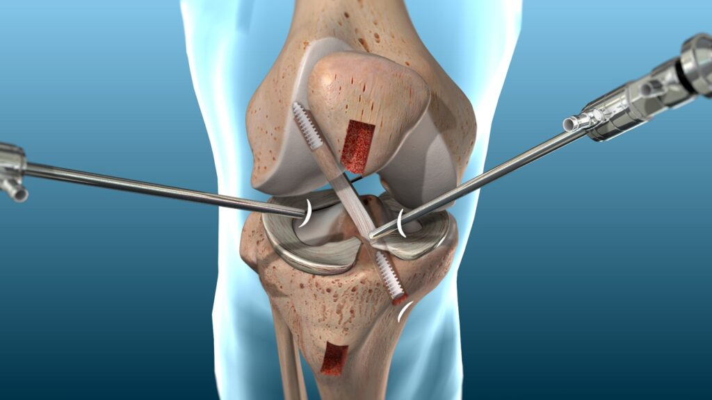 Signs of Progress in Non-Surgical ACL Healing: