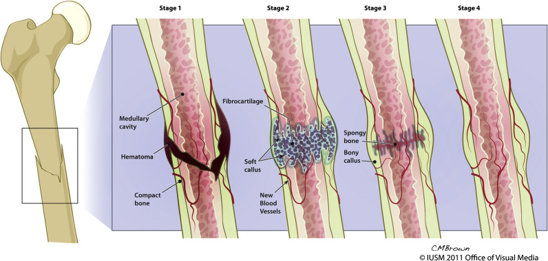 The Four Phases of Broken Ankle Healing and Recovery: