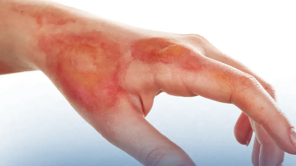 Moderate Friction Burns: (Deeper Skin Damage)