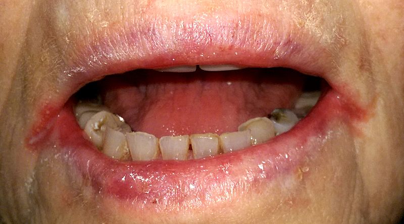 Understanding Cracked Lip Corners and Common Causes: