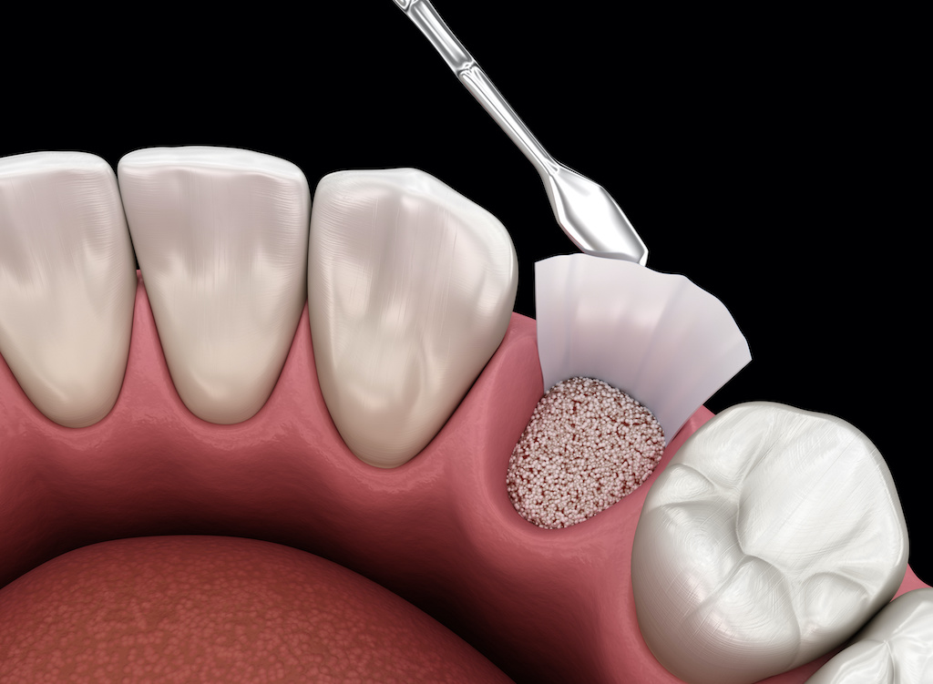 What is a Dental Bone Graft: