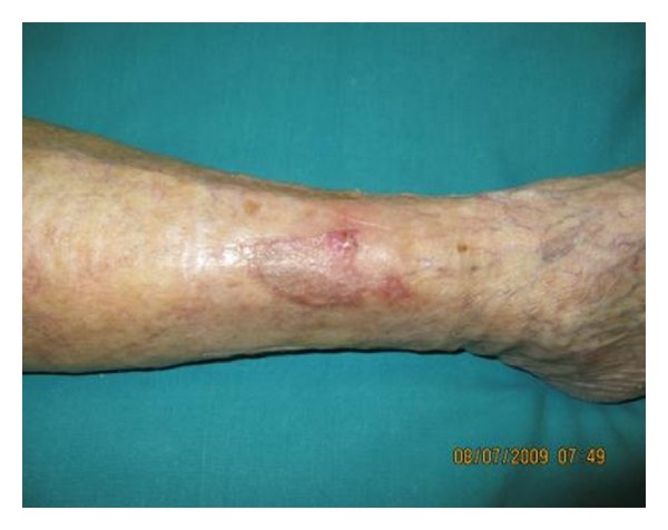 Revascularization: (Weeks 3-6)