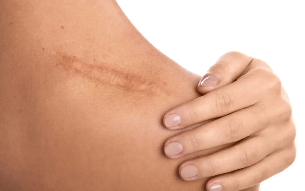 Tips for Faster and Healthier Scar Healing