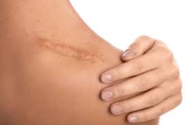 Factors That Affect Scar Healing Time: