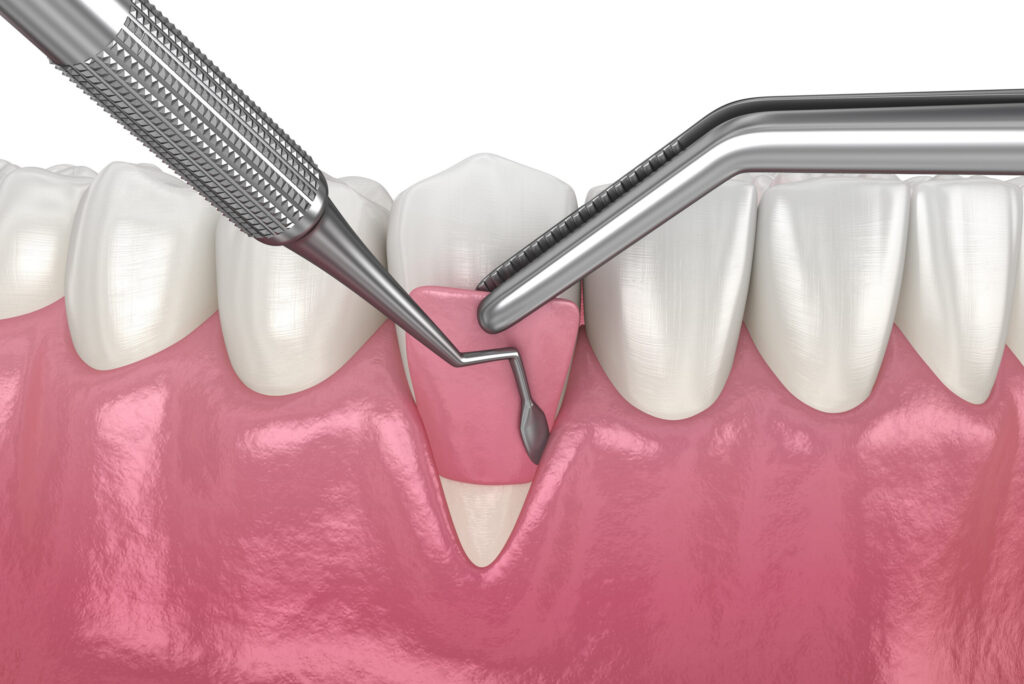 Preventing Dental Bone Graft Failure: