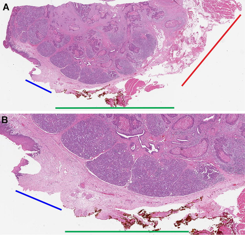 Factors That Influence Tissue Margin Separation: