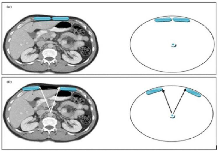 Tissue Margin Separation in Scar Formation: