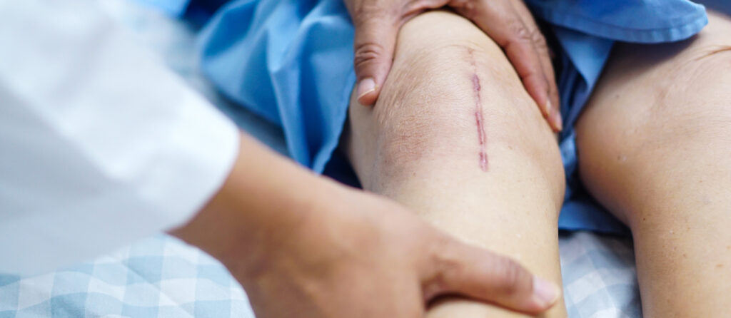 Caring for Stitches to Promote Faster Healing: