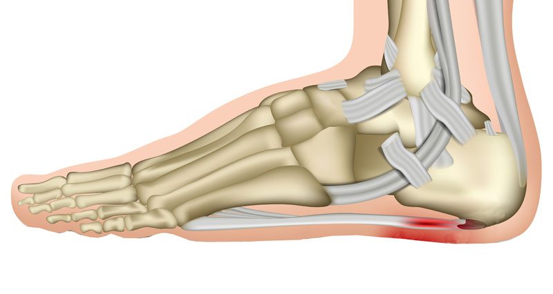 Common Misconceptions About Plantar Fasciitis Healing Time: