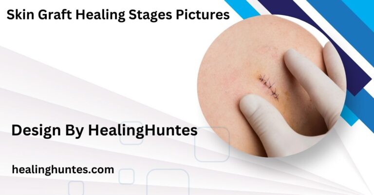 skin graft healing stages pictures