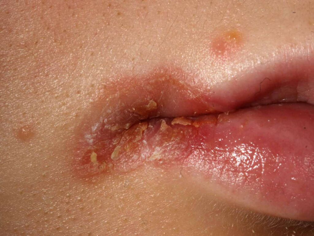 Understanding the Causes of Cracked Corners of Lips: