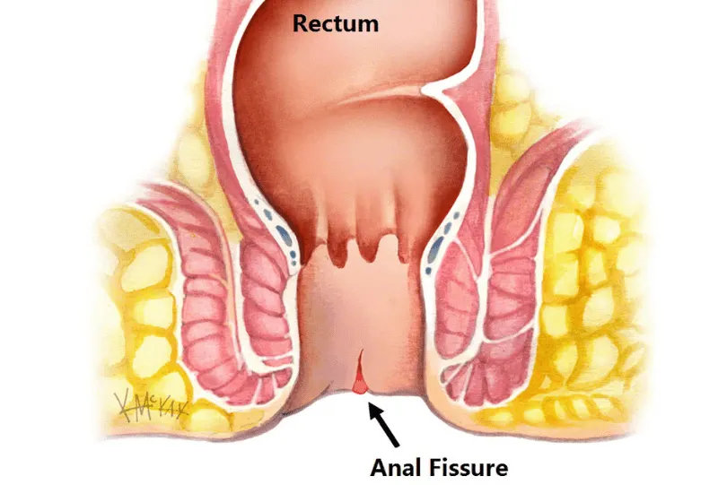 Signs a Fissure Is Healing: How to Recognize Recovery Progress?