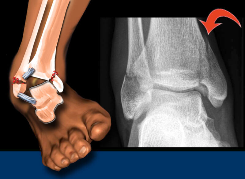 Understanding a Broken Ankle: