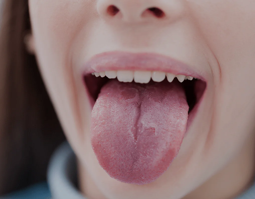 Immediate Remedies for a Burnt Tongue: