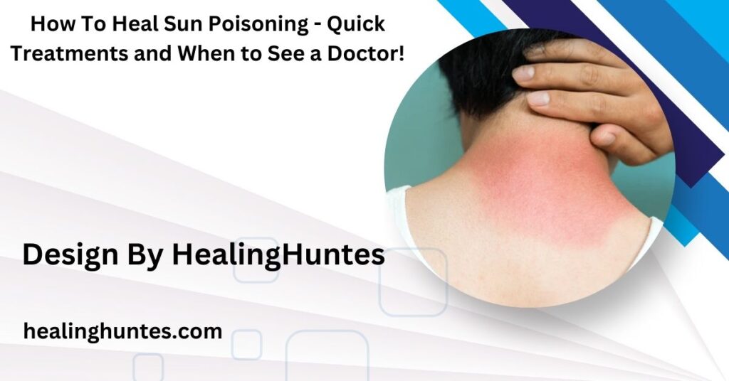 how to heal sun poisoning