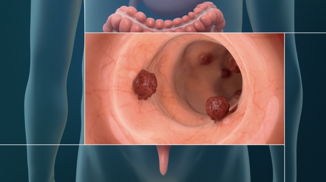 What is Stage 4 Colon Cancer: