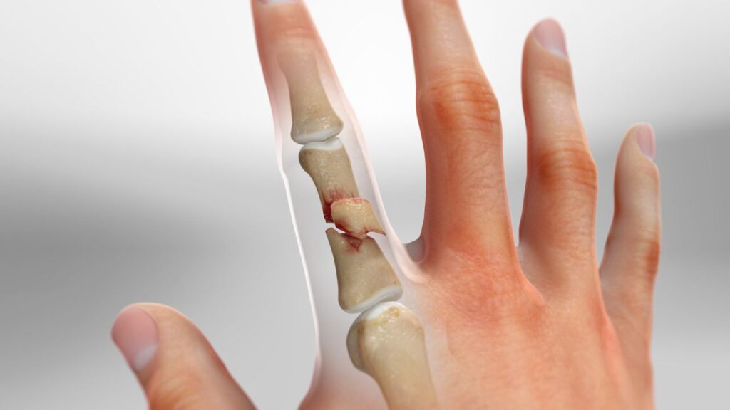 Understanding Finger Fractures: