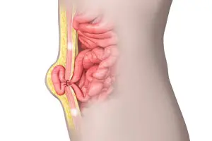 What Exactly Is a Hernia?